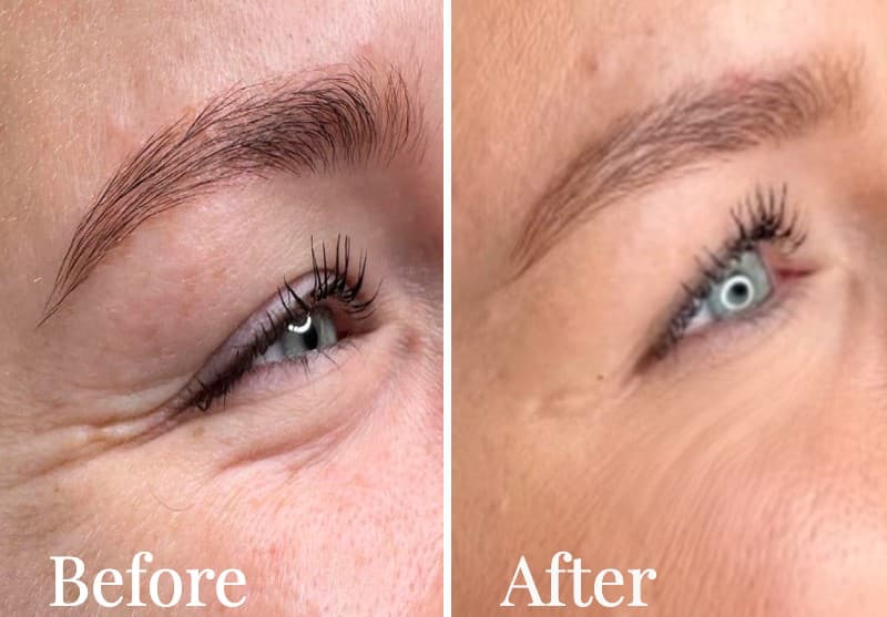 Close-up comparison of an eye: the 'before' image shows natural lashes and brow, while 'after' features anti-wrinkle treatment with enhanced lashes and smoothed brow.