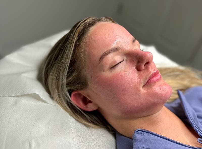 Woman lying down with closed eyes, post micro needling treatment.